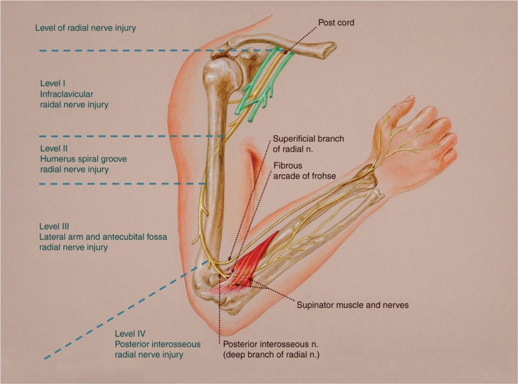Radial Nerve Injury Hand2Shoulder Clinic